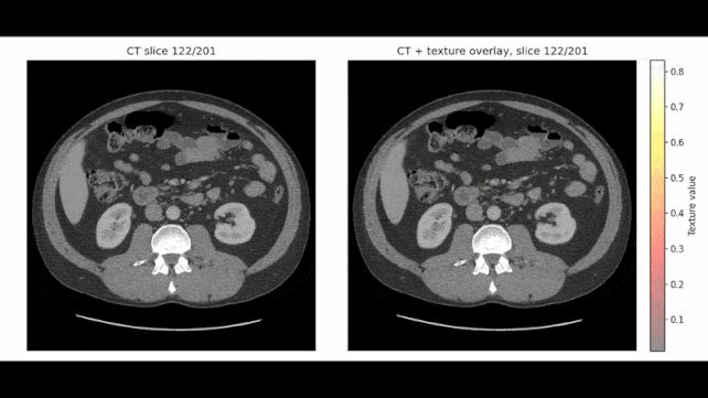 AI Can Spot Pancreatic Cancer Years Before Diagnosis, Study Finds