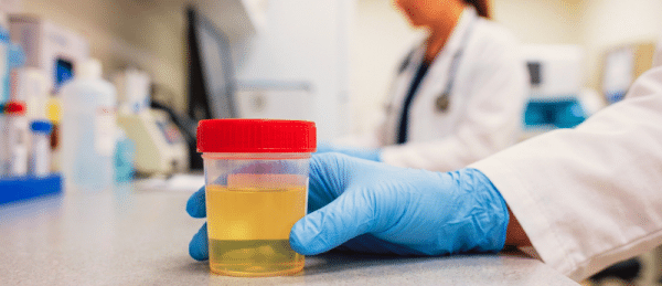 Non-invasive urine test identifies 9 in 10 bladder cancers